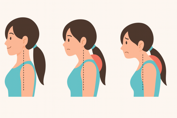 脖子僵硬-烏龜頸